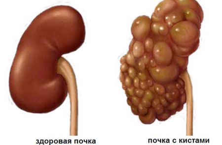 Мультикистоз почек у плода и новорожденного (мультикистозная дисплазия)