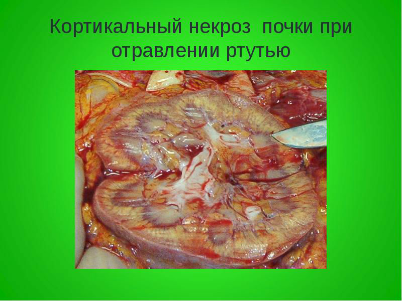 Некроз почки и эпителия извитых канальцев, что это такое