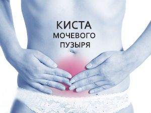 Киста мочевого пузыря у женщин и мужчин: симптомы, лечение