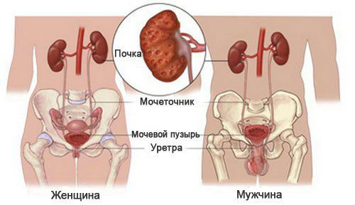 Пиелонефрит у женщин: симптомы и лечение хронической, острой формы