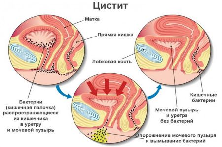 Частый цистит (постоянный): причины у женщин и что с ним делать