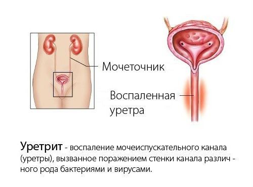 Трихомонадный уретрит у мужчин и женщин: симптомы и лечение