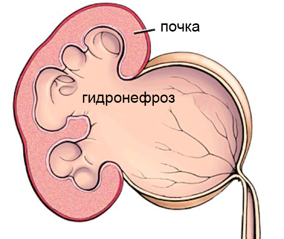 Причины увеличения почки у взрослых, новорожденных и детей