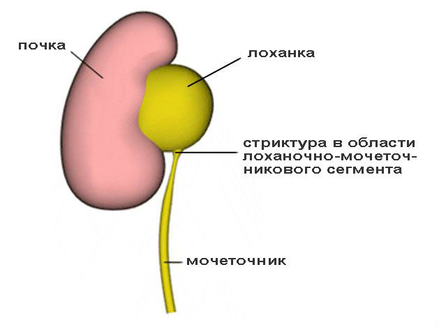 Каликоэктазия почек (левой, правой, обеих): что это такое, признаки