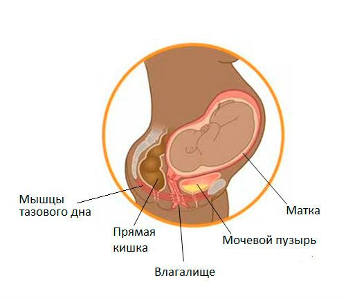 Каликоэктазия почек (левой, правой, обеих): что это такое, признаки