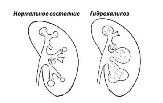 Каликоэктазия почек (левой, правой, обеих): что это такое, признаки