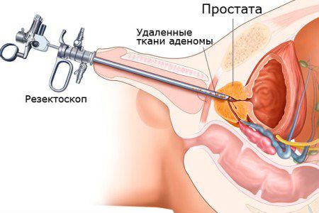 Недержание мочи после операции (радикальной простатэктомии, удаления аденомы)