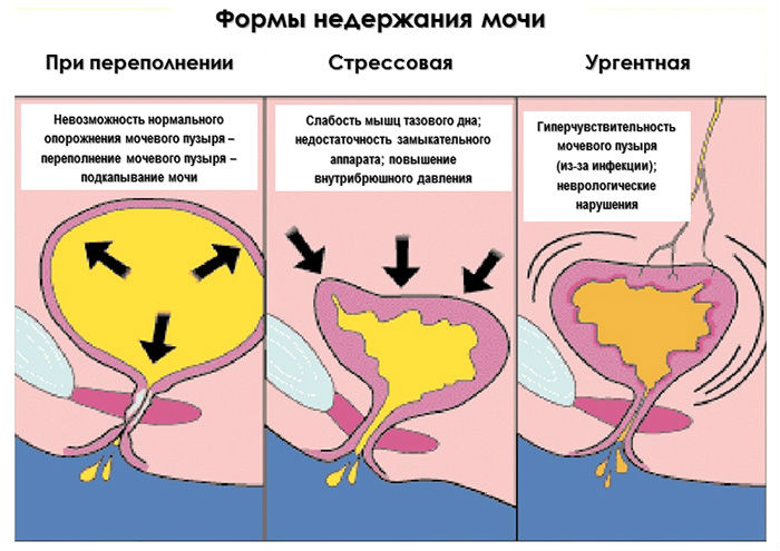 Недержание мочи после операции (радикальной простатэктомии, удаления аденомы)