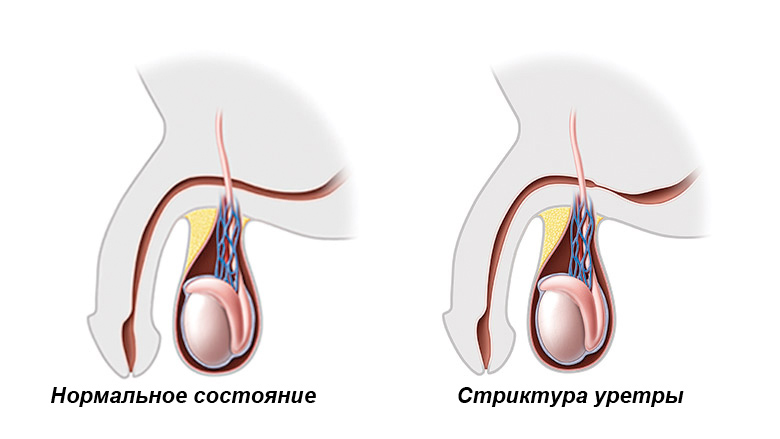 Стриктура мочеточника (сужение) и его лечение, бужирование
