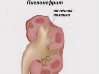 Инфекция мочевыводящих путей у детей и грудничков: причины, симптомы, лечение