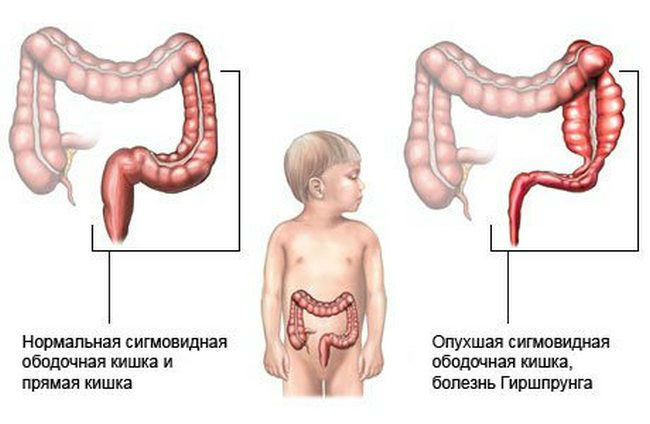 Экстрофия мочевого пузыря у детей и новорожденных