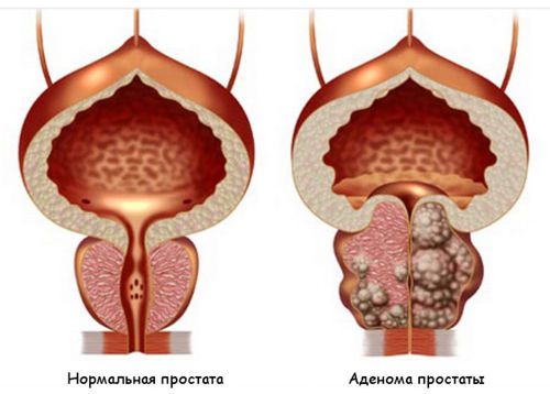 Болезни мочевого пузыря: симптомы у мужчин и женщин, лечение заболеваний