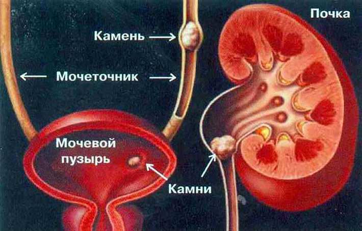 Расширена лоханка почки у взрослого: причины и лечение увеличенных лоханок