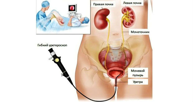 Расширена лоханка почки у взрослого: причины и лечение увеличенных лоханок