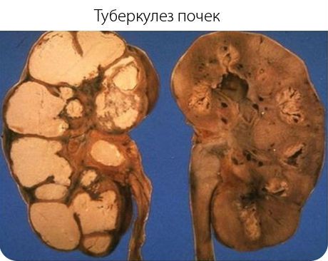 Туберкулез мочевого пузыря, почек и мочевыводящих путей: симптомы, лечение