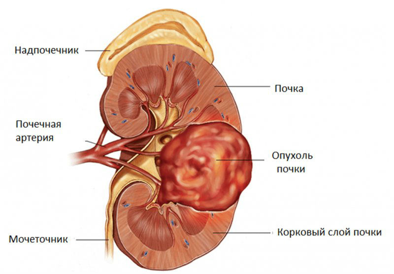 Светлоклеточный рак почки, прогнозы после удаления