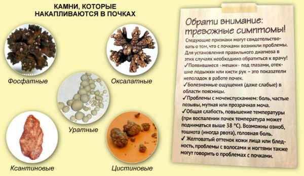 Коралловидные камни в почках (коралловые) и что с ними делать