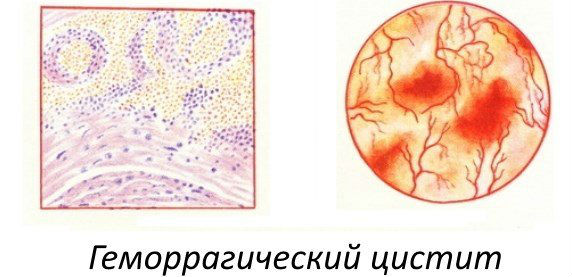 Цистит с кровью: что делать, лечение, причины кровотечений