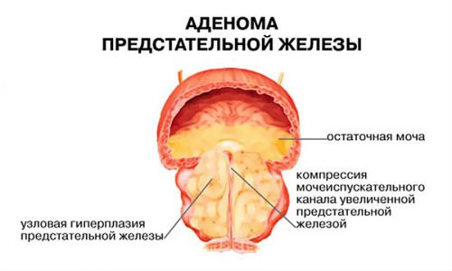 Цистит с кровью: что делать, лечение, причины кровотечений
