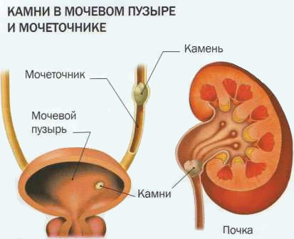Цистит с кровью: что делать, лечение, причины кровотечений