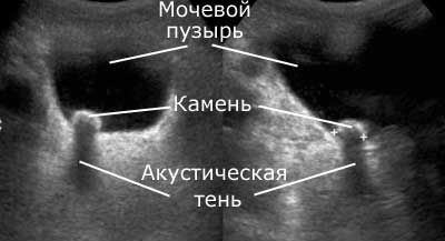 Цистит с кровью: что делать, лечение, причины кровотечений