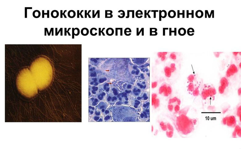 Гонококковый уретрит (гонорейный) у мужчин и женщин