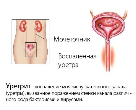 Гонококковый уретрит (гонорейный) у мужчин и женщин