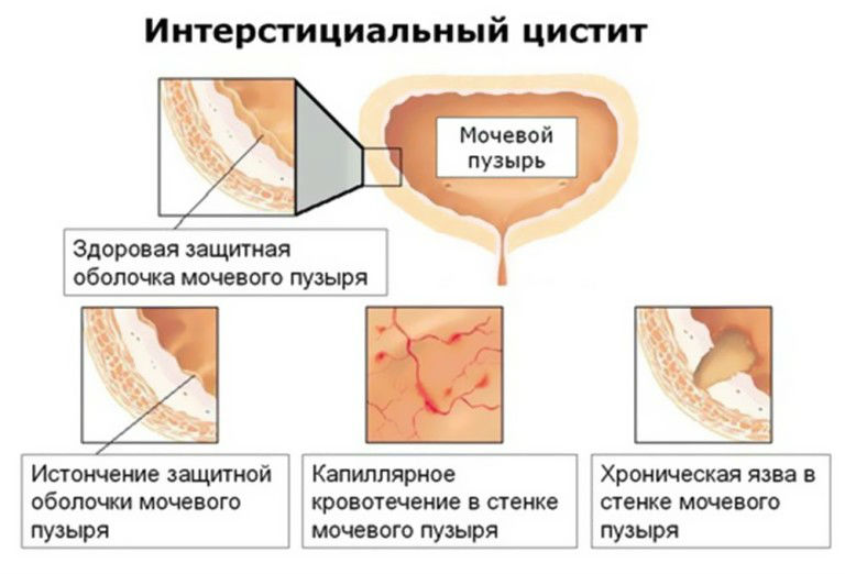 Интерстициальный цистит: симптомы, лечение и диагностика