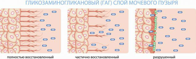 Интерстициальный цистит: симптомы, лечение и диагностика