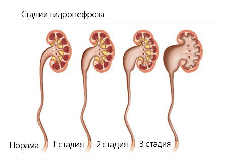 Гидронефроз при беременности и как вылечить эту болезнь почек