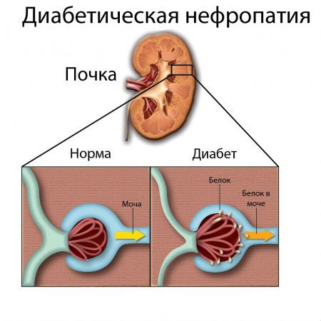 Обменная нефропатия у детей и взрослых