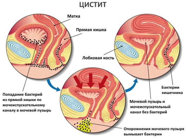 Цистит у женщин: симптомы и лечение, что это такое, виды заболевания