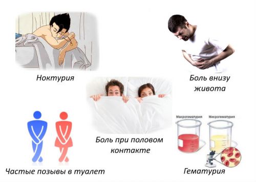Цистит у женщин: симптомы и лечение, что это такое, виды заболевания