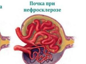 Сморщенная почка: что такое первичное и вторичное сморщивание, причины усыхания