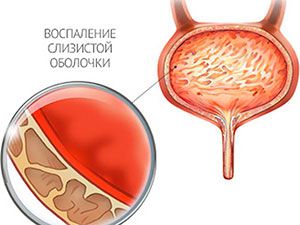 Цистит у мальчиков: симптомы и лечение, основные причины
