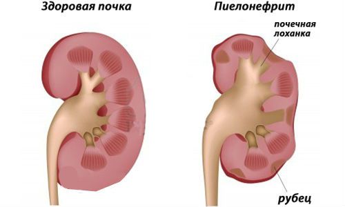 Гнойный пиелонефрит почек и его лечение