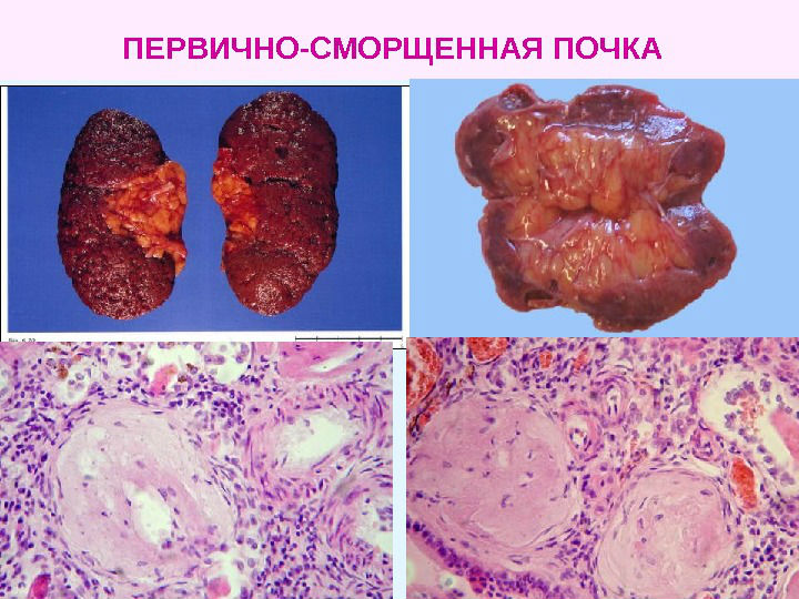 Мезангиопролиферативный гломерулонефрит, его лечение и симптомы