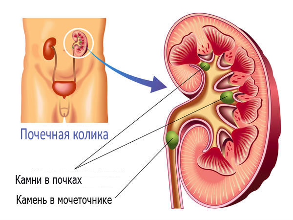 Почечная колика: как снять боль, лечение, что делать при приступе