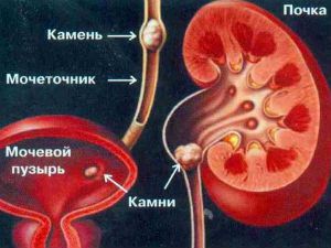 Почечная колика у женщин и мужчин: симптомы, лечение, алгоритм неотложной помощи