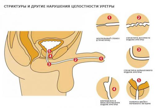 Уретрит у детей: симптомы и лечение у девочек и мальчиков