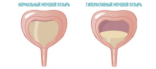 Частое мочеиспускание у женщин без боли: причины, лечение безболезненных позывов