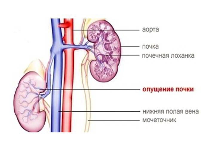 Опущение почки: причины и последствия, симптомы и лечение, чем это опасно