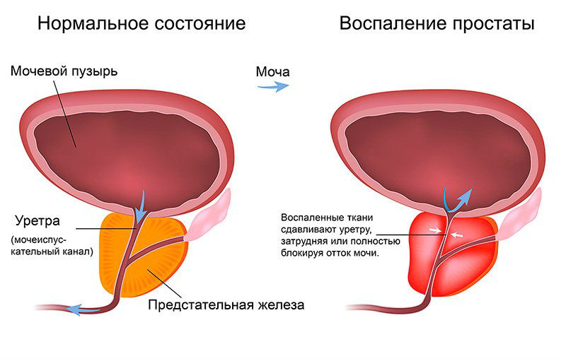 УЗИ мочевого пузыря с определением остаточной мочи: что показывает, как делают