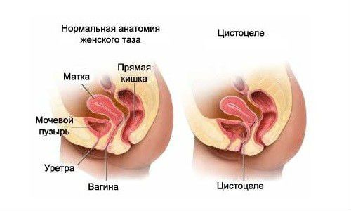 Болезни мочевого пузыря у женщин: симптомы, лечение заболеваний, признаки