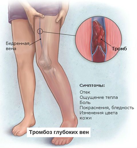 Антифосфолипидный синдром и беременность: диагностика, лечение, симптомы