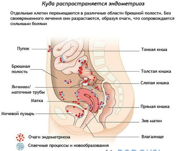 Эндометриоз мочевого пузыря: симптомы, лечение и причины