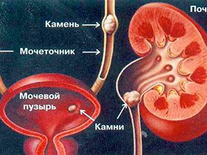 Как выходят камни из почек, симптомы у мужчин и женщин