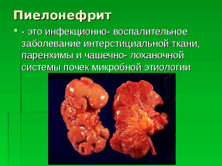 Клинические рекомендации по лечению пиелонефрита