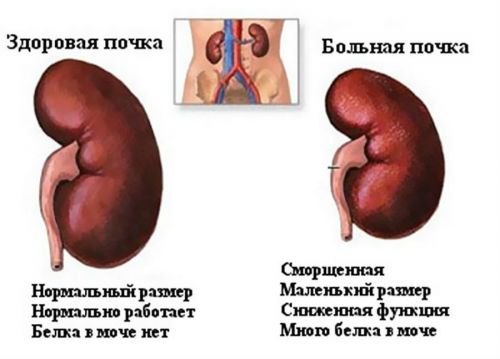 Увеличение лоханки почки у ребенка, в т.ч. у новорожденного