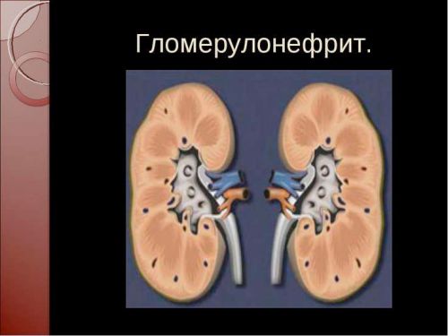 Классификация гломерулонефрита: хронический, острый и другие виды